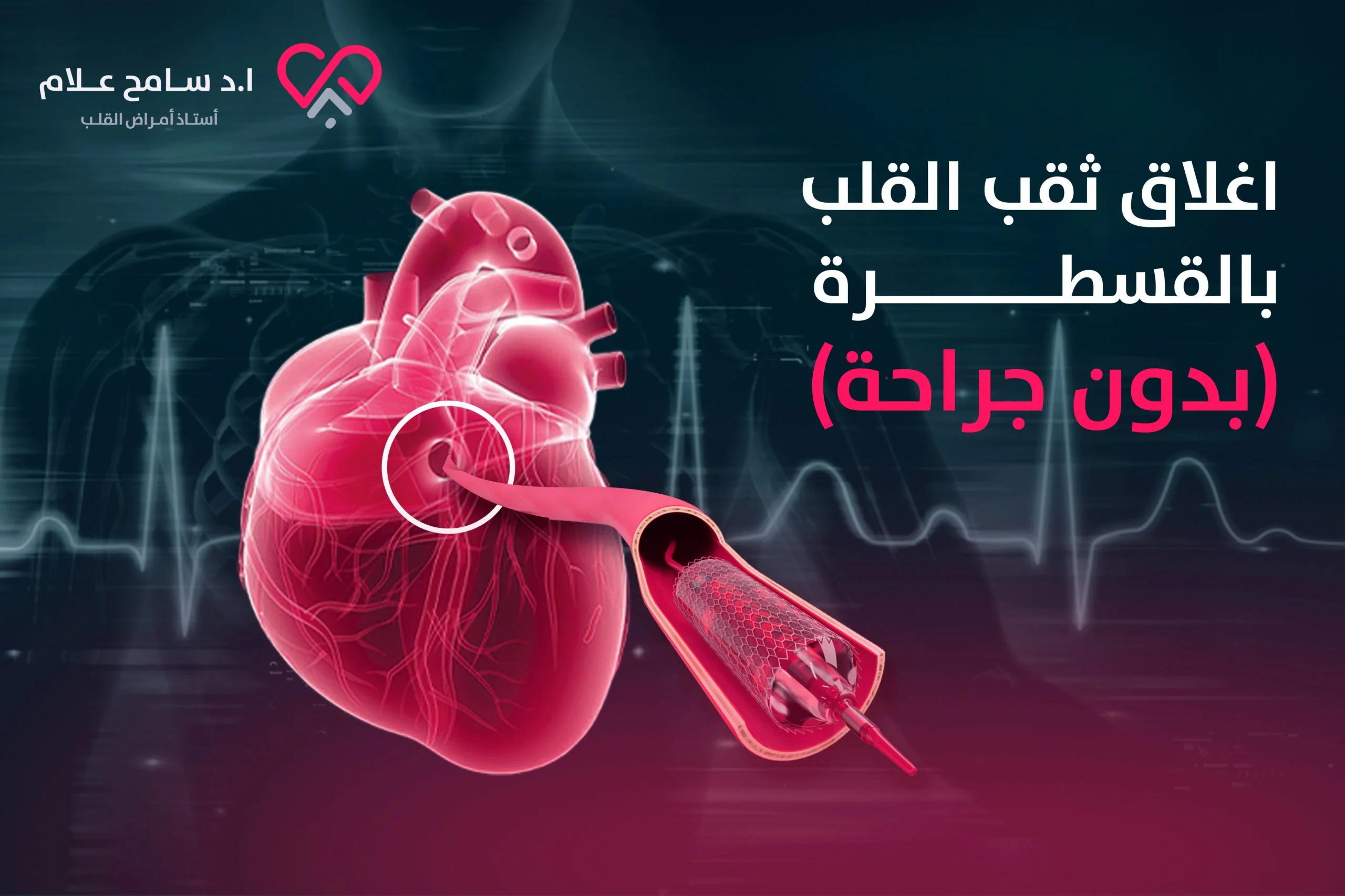 Header اغلاق ثقب القلب بالقسطرة