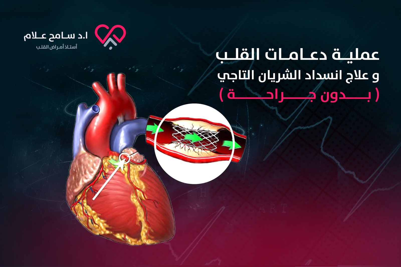 أفضل انواع دعامات القلب في علاج انسداد الشريان التاجي بدون جراحة