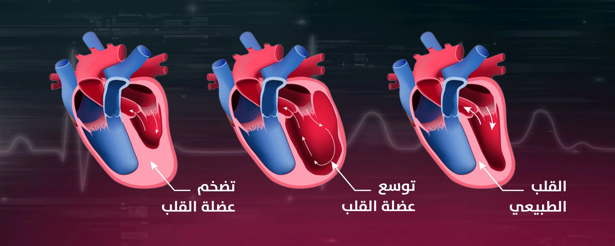 انواع-ضعف-عضلة-القلب اعراض ضعف عضلة القلب