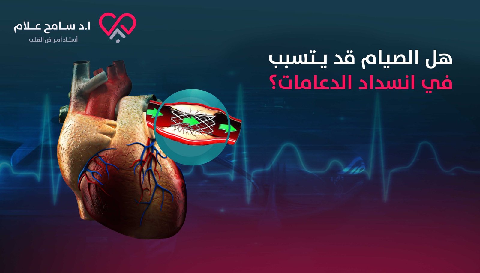 دعامات القلب والصيام دعامات القلب والصيام