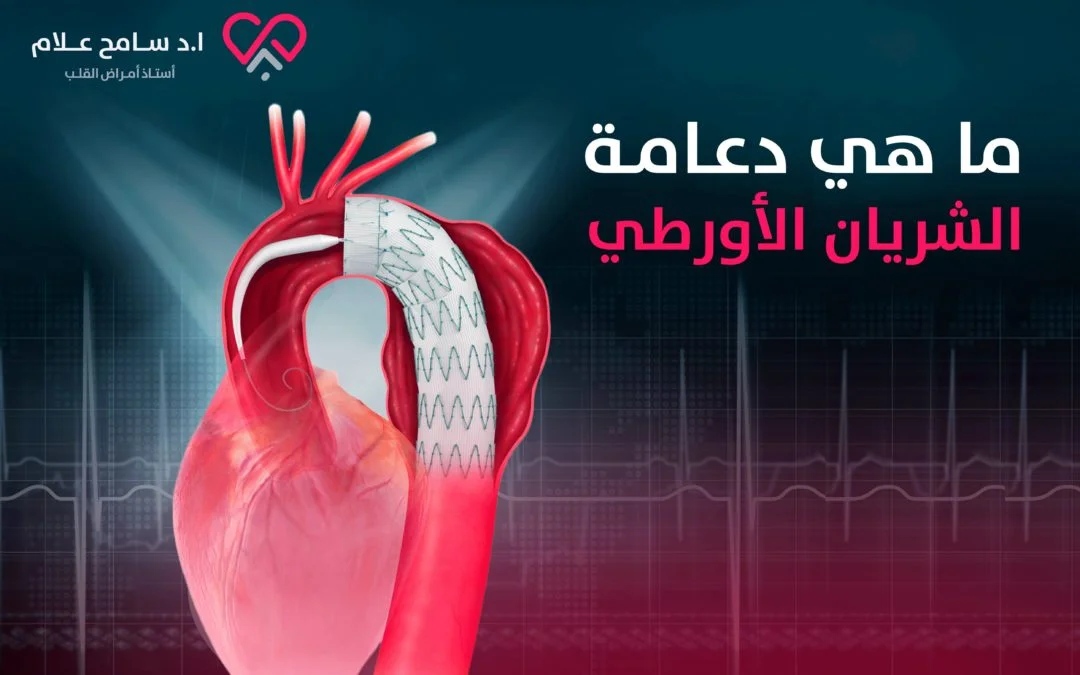 دعامة الشريان الأورطي
